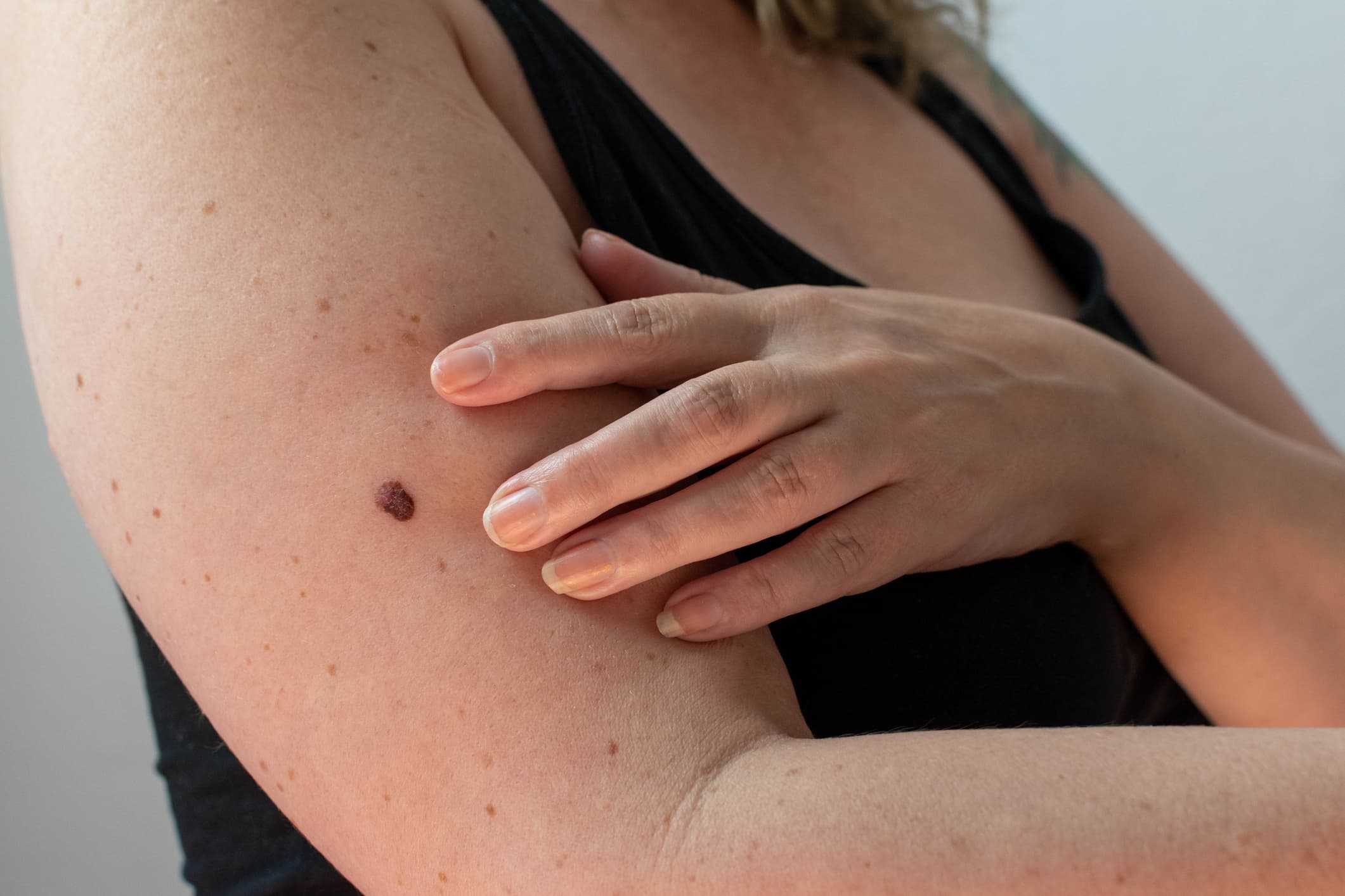 Kvinna som undersöker födelsemärke på armen. Läs vanliga frågor om leverfläckar och få läkarbedömning online via Doktera.se.