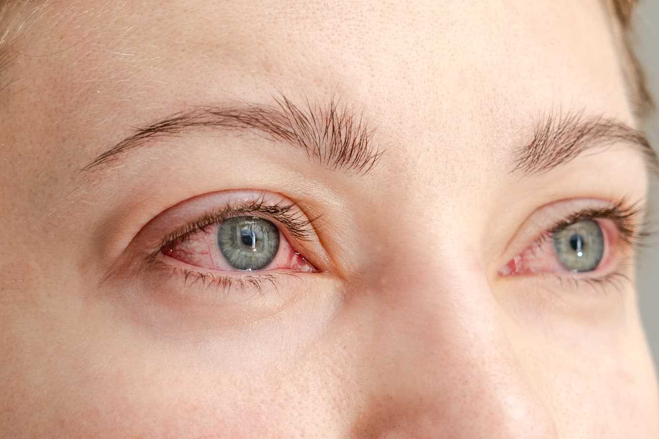 Närbild på röda och irriterade ögon vid allergiska ögonbesvär – symtom, egenvård och behandling hos Doktera