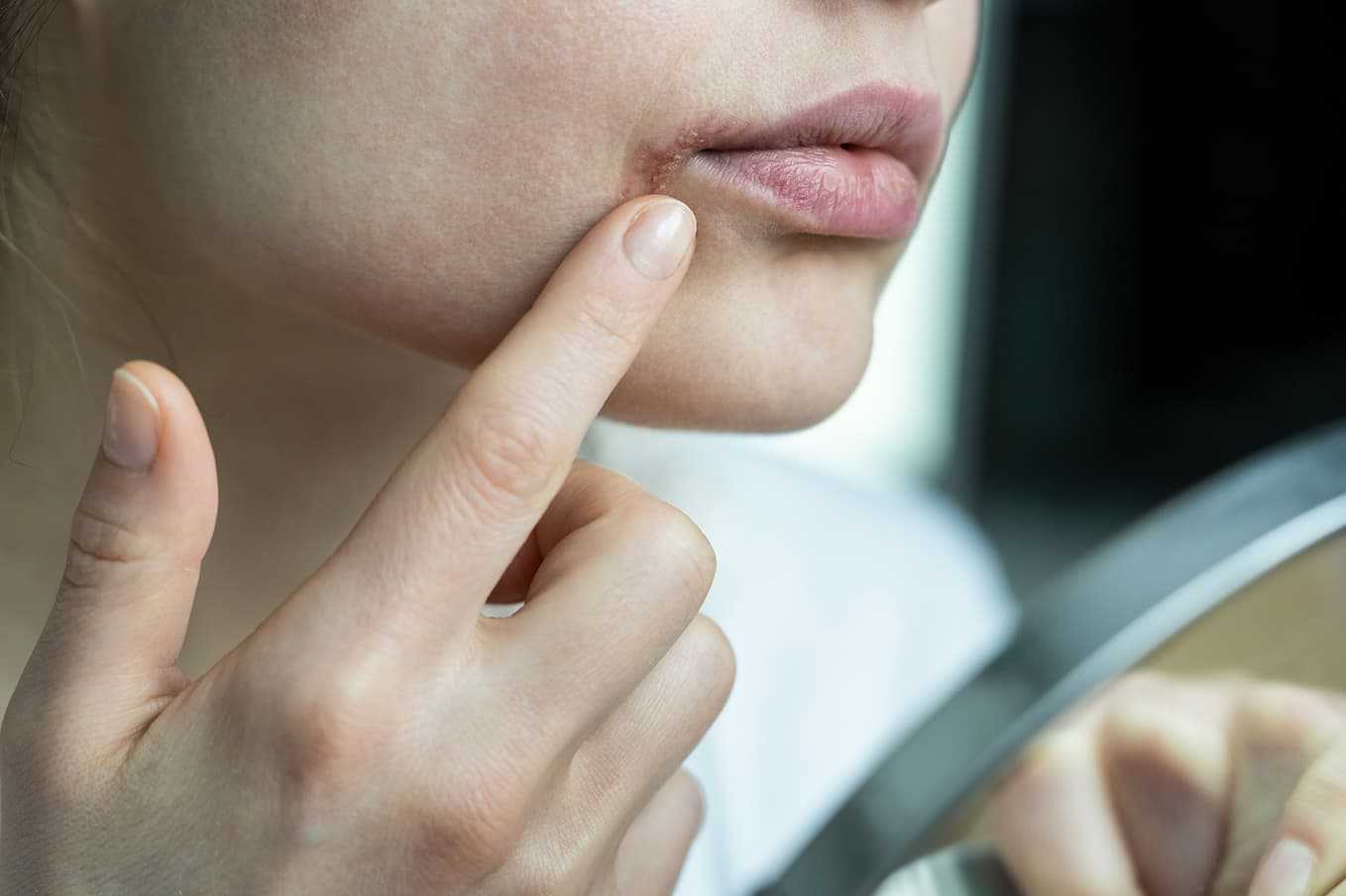 Närbild av en person med munsår orsakat av herpes simplex-virus (HSV-1). Personen pekar på en herpesblåsa vid mungipan, vilket är ett vanligt symtom vid utbrott av munherpes. Läs mer om diagnos och behandling av herpes på Doktera.